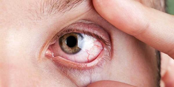 علائم بیماری خشکی چشم را بشناسید، برترین راه برای درمان